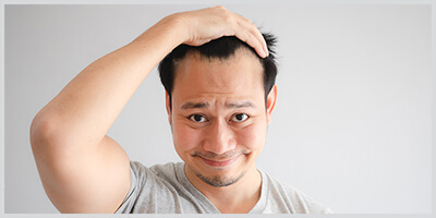 A receding hairline - the first sign of hair loss