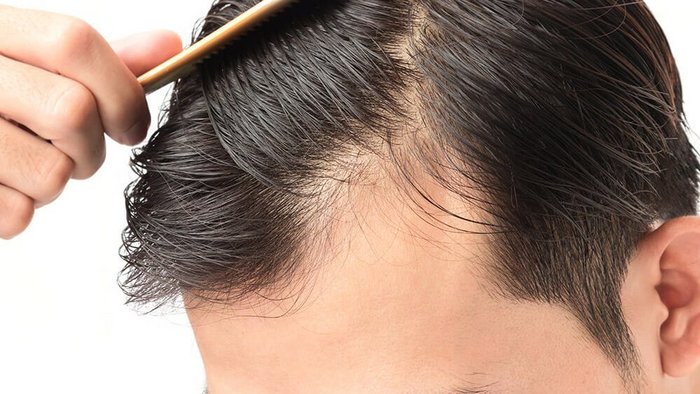 Diffuse hair loss in men - forms, causes and treatment