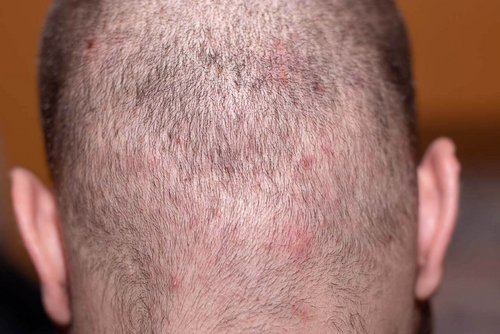 Red blotches or a reddened scalp, this is the skin's way of telling you it needs help.
