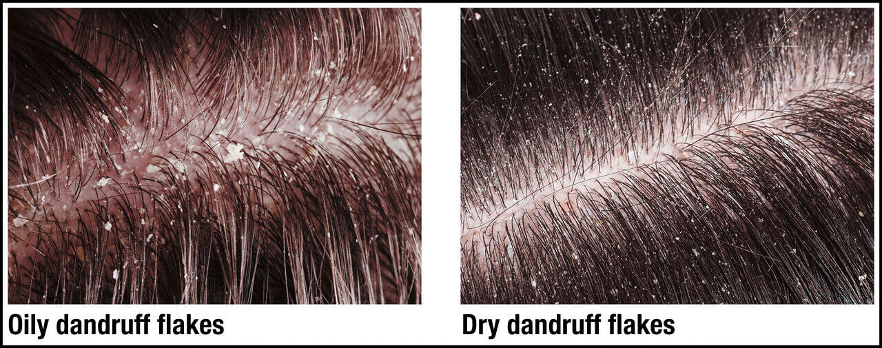 Dandruff - The difference between oily and dry dandruff