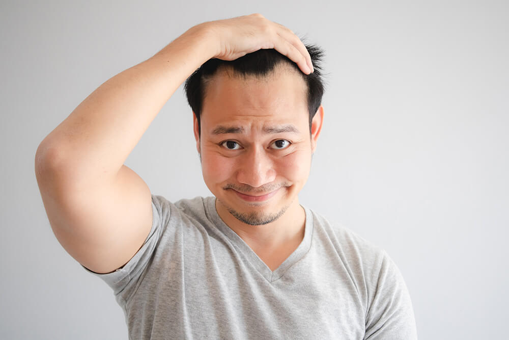 A receding hairline – what is that and how is it recognised?