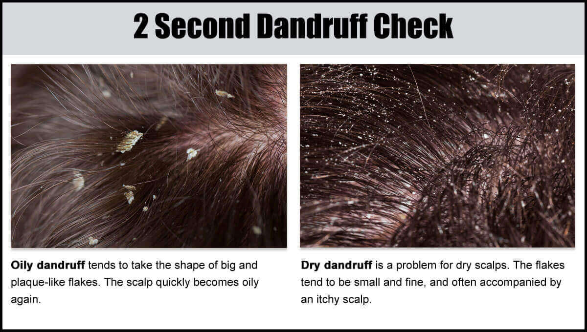 dry scalp white flakes