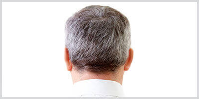 Probleme cu scalpul – Parul carunt